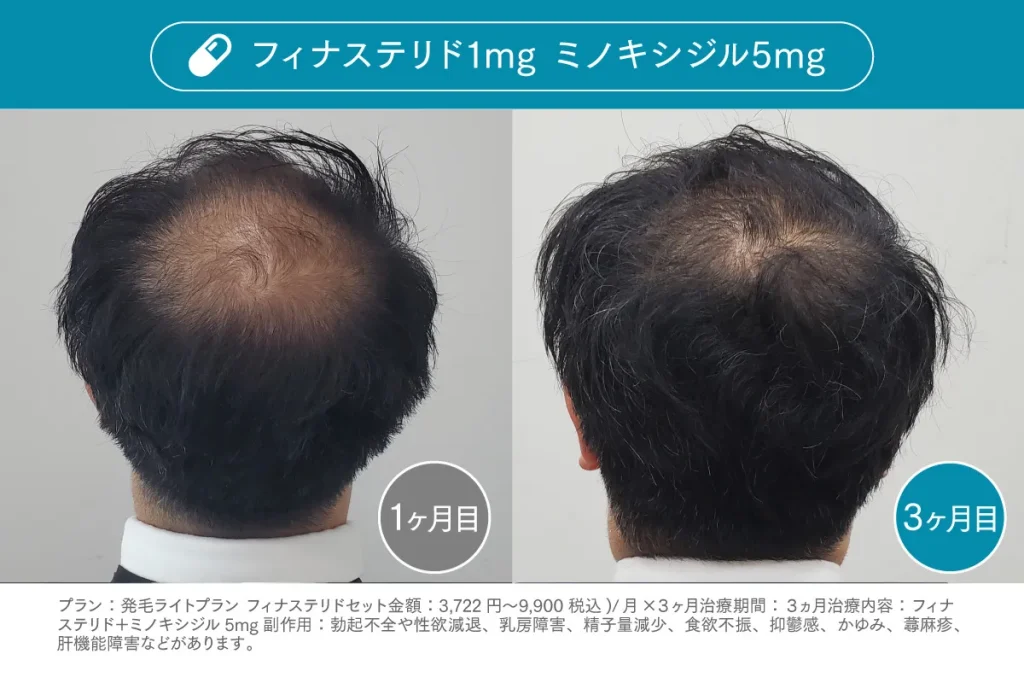 Before /After