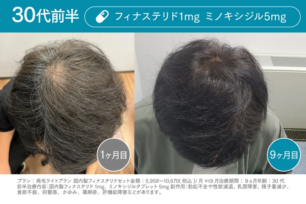 Before /After