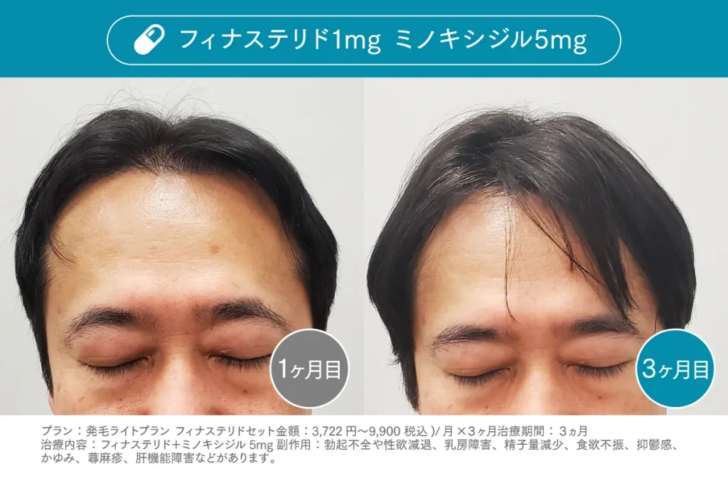Before /After