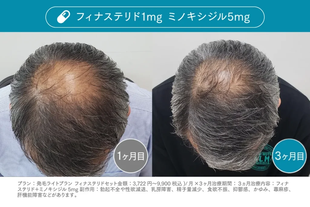 Before /After