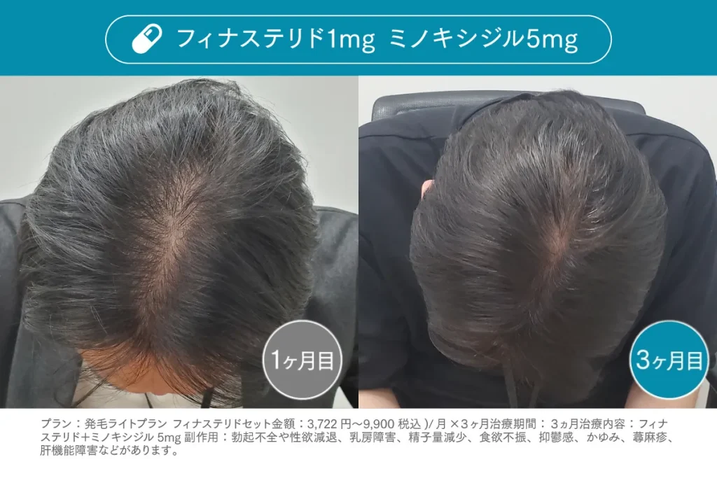 Before /After